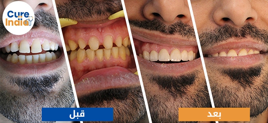 تلبيس الأسنان قبل وبعد الصور